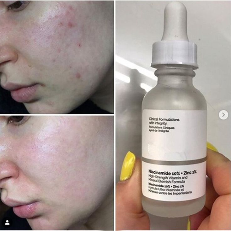 "Glow Naturally: The Ordinary Niacinamide 10% + Zinc 1% Serum"